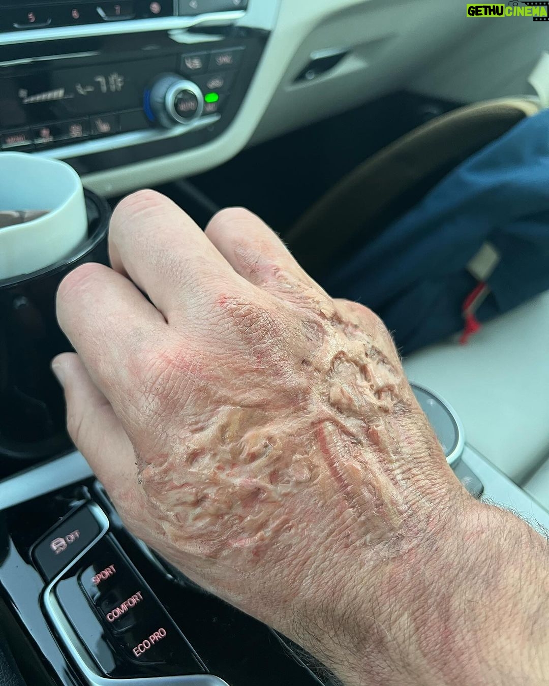 Paul Scheer Instagram - I had such a blast on AfterParty Season 2, @chrizmillr @theanthonyking @phillordy are the best. The only downside was that scar tissue was so cool I decided to keep it to show my kids and I think I scarred them instead. #afterpartyseason2 #poststrikeplugs