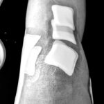 Zlatan Ibrahimović Instagram – For the past six months I played without an ACL in my left knee.
Swollen knee for six months.
I was only able to train with the team 10 times in the last six months.
Took more than 20 injections in six months.
Emptied the knee once a week for six months.
Painkillers every day for six months.
Barely slept for six months because of the pain.
Never suffered so much on and off the pitch.
I made something impossible to something possible.
In my mind I had only one objective, to make my teammates and coach champions of Italy because I made them a promise.
Today I have a new ACL and another trophy