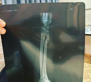 Alex Caceres Instagram - First I would like to thank my wife and teammates @zen_ronin_  and @themmalab, my managers @firstroundmgmt, as well as the @ufc for the opportunity. Tonight wasn’t my night, i broke my forearm blocking a head kick in the first round and tried my best to win even through the pain.
Hats off to @knockoutcancer for a grate fight