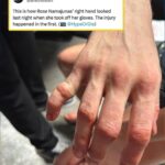 Andre Soukhamthath Instagram - Seeing this injury is bringing me back because this also happened to me. And the crazy part is it was around the exact same time in 2019!!! @rosenamajunas I feel you and props to you for finishing the fight. While someone else is trying to take your head off, you Can’t grip, can’t punch, can’t block, and it’s so painful.