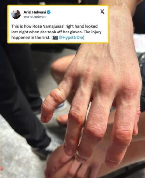 Andre Soukhamthath Instagram - Seeing this injury is bringing me back because this also happened to me. And the crazy part is it was around the exact same time in 2019!!! @rosenamajunas I feel you and props to you for finishing the fight. While someone else is trying to take your head off, you Can’t grip, can’t punch, can’t block, and it’s so painful.