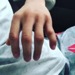 Andre Soukhamthath Instagram - Seeing this injury is bringing me back because this also happened to me. And the crazy part is it was around the exact same time in 2019!!! @rosenamajunas I feel you and props to you for finishing the fight. While someone else is trying to take your head off, you Can’t grip, can’t punch, can’t block, and it’s so painful.