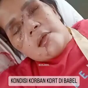 Baim Wong Instagram - Kejadian KDRT yg menimpa Ibu Nurlela ini membuat saya harus ke pulau Bangka. 

Ibu Nurlela hanya ingin bertahan hidup demi anak2nya. Walaupun mata sudah diremukkan, tangan patah, dagunya sudah robek, dia tetap tegar krn mendengar tangisan anaknya. Dia hanya berdoa, untuk dipanjangkan umurnya untuk bisa mengurus anak2nya. 
Dan setalah menjalani 3 kali oprasi, alhamdulilah skrg keadaan Ibu Nurlela sudah membaik walaupun harus kehilangan 2 matanya. 

Kita yg sehat2 seperti ini, jgn malas kalau harus mengurus anak. Ada org yg mau mengorbankan hidupnya demi masa depan anak.