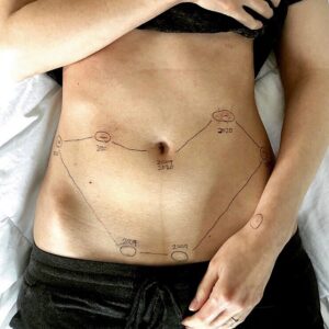 Courtney Ford Instagram - 1/3
(The photo above is of me two years ago, inspired by @georgiewileman’s #ThisIsEndometriosis campaign)

Many of you shared your own experiences with endometriosis in the comments below my post about Dr. Kent. I wanted to let you know that I see you, and can share a bit of my personal experience if it helps. 

For those unfamiliar, endometriosis is an inflammatory disorder that occurs when cells similar to the lining of the uterus are found in areas outside of the uterus, causing significant pain. It is not just a “painful period”, and its effects aren’t limited to the days surrounding menstruation. My symptoms were felt nearly every day, and alternated between aching, stabbing and nausea, creating fatigue and a constant buzzing in my brain that I can only describe as “pain fog”. All in all a 0/10, would not recommend.

Six years after my surgery with Dr. Kent, and two years after the birth of my son, pain slowly began to creep back into my body. By 2020, the symptoms had become overwhelming, and I had my 2nd surgery during our first pandemic Christmas. That timing also gets a 0/10.

Although Dr. Kent had retired, serendipity led me to a surgeon that specialized in excision, rather than laser ablation. This surgeon is an absolute warrior queen, and I will introduce you to her in a separate post. My post-op notes revealed:
Stage 4 endometriosis (which she excised), suspected adenomyosis, and interstitial cystitis. I also lost my appendix.