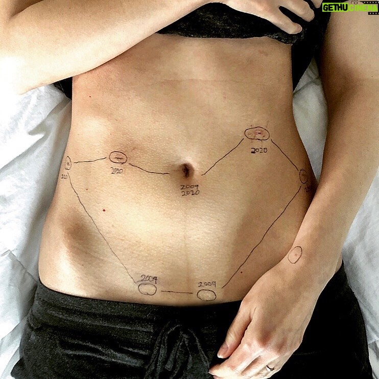 Courtney Ford - 16.7K Likes - 1/3
(The photo above is of me two years ago, inspired by @georgiewileman’s #ThisIsEndometriosis campaign)
Many of you shared your own experiences with endometriosis in the comments below my post about Dr. Kent. I wanted to let you know that I see you, and can share a bit of my personal experience if it helps.
For those unfamiliar, endometriosis is an inflammatory disorder that occurs when cells similar to the lining of the uterus are found in areas outside of the uterus, causing significant pain. It is not just a “painful period”, and its effects aren’t limited to the days surrounding menstruation. My symptoms were felt nearly every day, and alternated between aching, stabbing and nausea, creating fatigue and a constant buzzing in my brain that I can only describe as “pain fog”. All in all a 0/10, would not recommend.
Six years after my surgery with Dr. Kent, and two years after the birth of my son, pain slowly began to creep back into my body. By 2020, the symptoms had become overwhelming, and I had my 2nd surgery during our first pandemic Christmas. That timing also gets a 0/10.
Although Dr. Kent had retired, serendipity led me to a surgeon that specialized in excision, rather than laser ablation. This surgeon is an absolute warrior queen, and I will introduce you to her in a separate post. My post-op notes revealed:
Stage 4 endometriosis (which she excised), suspected adenomyosis, and interstitial cystitis. I also lost my appendix.