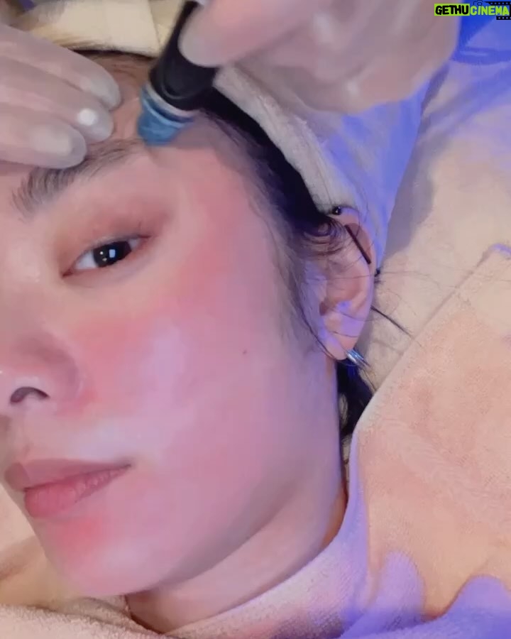 Erol Instagram - 趁這次去韓國之前去體驗了水飛梭 因為本身皮膚屬於乾肌➕敏感肌 擔心去了又冷又乾的韓國沒辦法拍出好看的照片 跟 @2.17__ 做了諮詢後,決定在 @myniceclinic 試試看 先說結論 做完海飛秀水飛梭後 真的感受到肌膚被深度清潔,過程中完全無痛感 這台機器厲害的點在於,在清潔的同時也在導入精華液,可以做到清潔又保濕的修護 最後又加購了三倍光雷射 也就是俗稱的脈衝光,可以縮小毛孔、減少細紋 改善膚色不均的問題,一樣沒什麼痛感 我連麻醉藥膏都跟護理師說不用敷了 ☝🏻☝🏻前兩張照片是在韓國剛睡醒素顏拍的☝🏻☝🏻 最後我要強調一點✨ 「完全沒有恢復期」✨ 整套療程做完後臉沒有紅腫、泛紅 這對我來說蠻不容易的,平常是連敷臉 都很容易過敏的體質 ☝🏻☝🏻☝🏻第三張影片做完療程後的一小時沒有上底妝☝🏻☝🏻☝🏻 超~級~亮 前幾天用手機原鏡頭直播,觀眾們一直問 為什麼皮膚那麼好!因為有保養真的有差 任何相關問題都可以直接私訊 @myniceclinic 啊 報Erol會有小驚喜不要害羞趕快試試看吧 #耐斯診所 #niceclinic #水飛梭 #海飛秀 #hydrafacial#例行保養 #懶人保養 #黑頭粉刺#內包型粉刺 #清粉刺 #痘痘改善#三倍光雷射#脈衝光雷射#台北醫美診所 #東區醫美