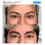 Fox Fisher Instagram – Trans masculine affirming non-surgical procedures aren’t talked about enough, and it’s something that’s brought me instant euphoria 🏳️‍⚧️🌟

I wasn’t blessed with big bushy eyebrows, but this allowed me to achieve something that gives me euphoria about the way I look. And I know, for many trans people, little things like this can make such a difference. 

Thanks @drvincentwong and @jademendes 💜

Before coming out, I started to feel the pressure to conform to stereotypes about how girls are supposed to dress and behave. So, at the age of 11, I signed up for a finishing-school type class, which taught tweens and teens how to preen and prettify our faces.

For my eyebrows specifically, the teacher used me as the example model – showing the girls the best tweezers, where to pluck and how much to remove. This gave me fashionably thin brows, very femme.