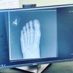 Griffin Wallace Henkel Instagram - #Broken toe in #two places