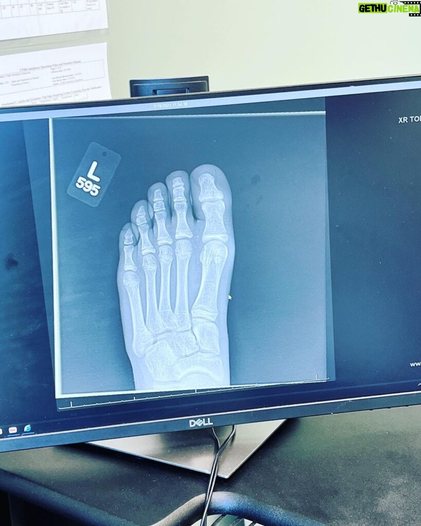 Griffin Wallace Henkel Instagram - #Broken toe in #two places