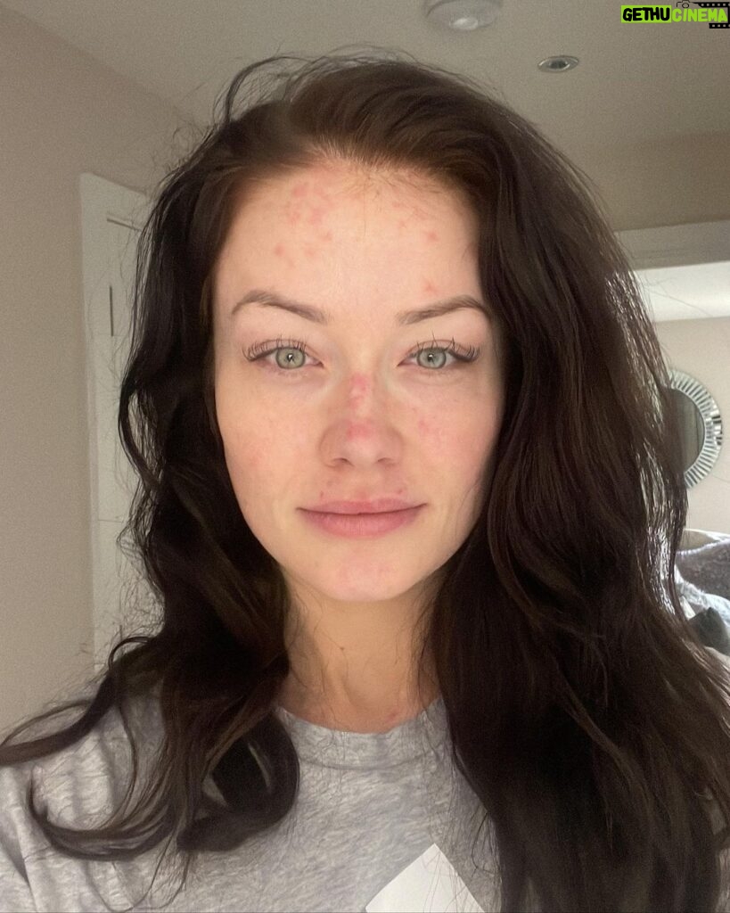 Jess Impiazzi Instagram - A lot has been going on here since the start of the year!… I don’t know where to begin! Obviously I was very open with the IVF journey and the process, but during that time and pretty much since early January I had been getting sicker and sicker, this was with inflammation, stomach issues that were debilitating. As the months rolled on I’d have muscle spasms, my joints would swell and I’d be unable to move my entire body, my eyesight got worse, the fatigue was something and is still something I’ve never experienced before. From being in the gym nearly everyday and running 5k’s this has just been horrid. Then I got rashes all over my chest arms and face (I’ve learnt how to cover them well with make up, but without it it’s horrible down my nose and my whole forehead) In July I had three trips to A&E from the pain, I just knew I was getting worse and I was really struggling! Mentally it’s taken a toll, if the IVF and that failing wasn’t hard enough this was topping it off! After many, many tests and lots of blood taken I was diagnosed with a chronic autoimmune disease called Lupus. (Swipe along to see more info on lupus taken from @lupus_uk) I am currently on steroids to get this under control and then see what the future holds medication wise but having a diagnosis helps as I can now work with the doctors to get myself living again and do whatever it takes to keep my body in the best working condition! I’ve had amazing friends and family supporting me! (You know who you are!) I’m looking in to something’s as to why it’s happened and what may have caused it although it’s hard for doctors to establish that, however I did have an operation late December last year that I feel may be linked. (I’ll talk about this in detail once I know more) If anyone has autoimmune issues especially lupus please reach out and let me know ways that may have helped you! Anyways… that’s what’s been going on lately and have felt a little bit lost but I’m finding my feet again! I’ll bounce back with tweaks and get the show back on the road! 🌈🦋💖 peace and love to everyone 💖🎀🦋 a thank you to @susehilly for helping me tell my story in todays paper 💖. #lupus #autoimmune #ivf