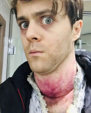 Joey Batey Instagram - Feeling a bit under the weather for some reason. Anyone know a decent remedy?...
...
#witcher #netflix #behindthescenes