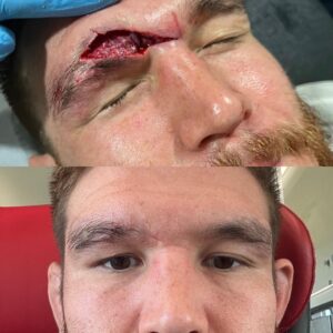 Johnny Eblen Instagram - Hatchet wound update.. still beautiful 😘 healing like wolverine in this bish!