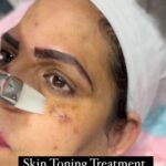 Karate Kalyani Padala Instagram - Thank u so much @karatekalyani garu for choosing us for Skin Toning session Budget friendly Offers available with us are below 1. Hair reduction Select any 2 parts (upperlip)(side locks)(chin)(lower lip)999/- per sitting 2. under arm laser per sitting only for 999/- 3. Full face laser per sitting only for 3500/- 4. full hands full legs underarms 6 sittings 29999/- 5. full body laser 6 sittings only for 44999/- 6. tatto removing per inch per sitting for 399/- 7. Party peel for 999/- 8. Hydra facial 1999/- 9. glowup session 4999/- 10. carbon peel facial 1999/- 11. Skin toning session 4999/- For appointment reach us on 7799825558 Branches Kondapur branch: https://maps.app.goo.gl/sadczyMyr7NePNkb7?g_st=ic KPHB Branch: https://maps.app.goo.gl/gwM9wnnCrytmgNe58?g_st=ic
