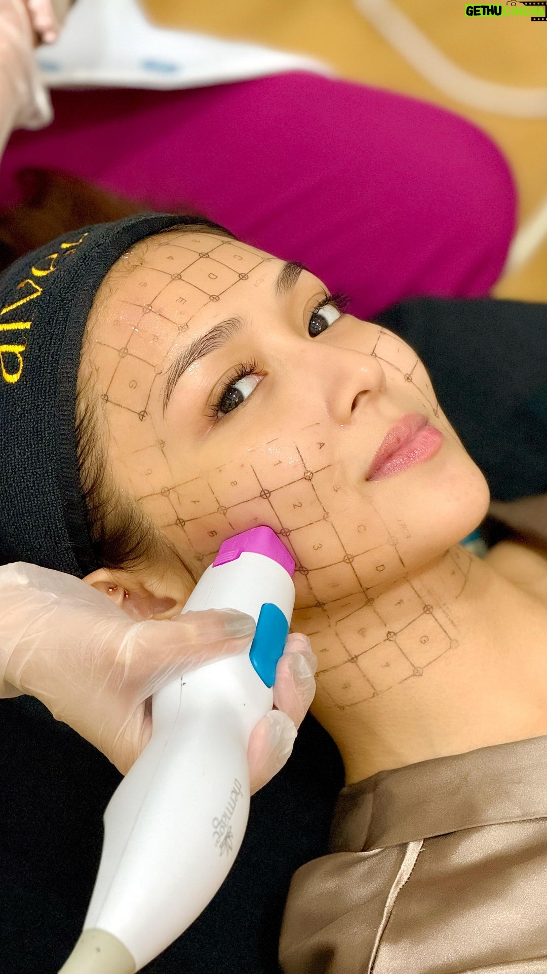 Kathryn Bernardo Instagram - @bernardokath starting the year strong with her favorite annual skin tightening and lifting AIVEE THERMAGE! ππ― β
AIVEE THERMAGE is a skin tightening treatment that utilizes radio-frequency (RF) energy to heat the deep layers of the skin. This heat stimulates the production of collagen and elastin, which are the proteins responsible for skin strength and elasticity. As a result, it can diminish the appearance of fine lines and wrinkles, enhance skin tone and texture, and tighten loose skin. DISCLAIMER: Treatments and procedures depend upon consultation. We highly encourage our patients to be examined by our doctors for us to prescribe the proper treatments for your skin and body concern. Treatment costs may be discussed upon consultation. Book your appointment/consultation now by calling or sending us a message here! +639209665613 - Surgery Hotline +639177283838 - Local Hotline +639614514572 - International Hotline +639692230499 - Whatsapp/Viber Or you may call our branches at: π A-INSTITUTE, BGC: +63917 521 0222 π FORT, BGC: +63920 966 5529 π MEGAMALL: +63917 871 9500 πVERTIS NORTH: +63917 164 4170 π ALABANG: +63917 537 4200 #aivee #theaiveeclinic #aiveeclinic #aiveeday #aiveelove #aiveeleaugue #draivee #drzteo #aiveethermage