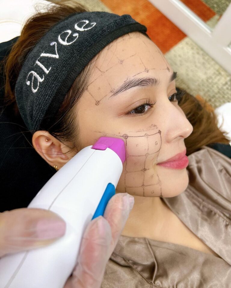 Kathryn Bernardo Instagram - It’s that time of the year! 💆🏽‍♀️ Just can't skip my annual Thermage FLX with @theaiveeclinic & @draivee. Thank you for making sure I was comfortable the whole time, @keli.fashion. 😚