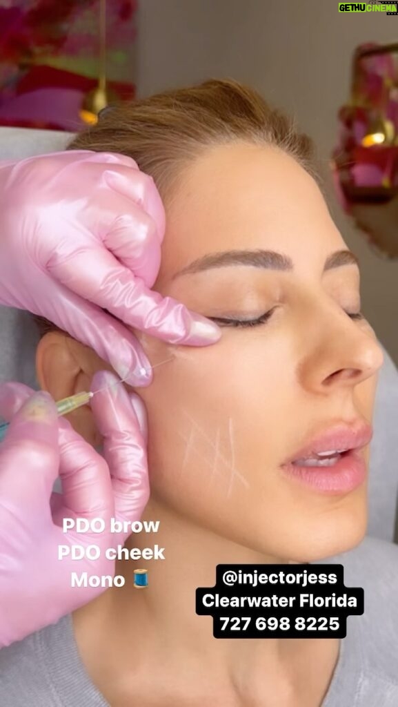 Kerri Kasem Instagram - Watch as I use a combination of @mintpdo PDO barbed and mono threads to snatch @kerrikasem ! I did my signature PDO brow and cheek lift as well as adding some mono threads aka spanx for the skin to her tear troughs and smile lines. What do you think ?! Text 727 698 8225 to book or train with National Trainer Jessica Manges ARNP #nonsurgical #nonsurgicalfacelift #pdothreads #pdothreadlift #dermalfillers #pdobrowlift #teartroughfillers #monothreads