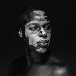 Kytao Instagram - VITILIGO @ablayevitiligo @frenchcutlife FRENCH CUT