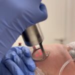 Ma'Ma Queen Instagram - Een van onze favorieten behandelingen die we bij Signé mogen uitvoeren, is de CO2-laser 🤍. De laser wordt ingezet voor huidverstrakking, het verminderen van (acne)littekens en bij het behandelen van een grove huidstructuur. De huid wordt tijdens de behandeling gecontroleerd beschadigd, waardoor het lichaam wordt aangespoord om collageen aan te maken. Na een herstelperiode van ongeveer een week is het resultaat een stralende, stevige en vernieuwende huid! Wij hebben @iammamaqueen mogen ontvangen in onze kliniek voor de CO2-behandeling. Zij zal het verdere proces met jullie delen, stay tuned🤍