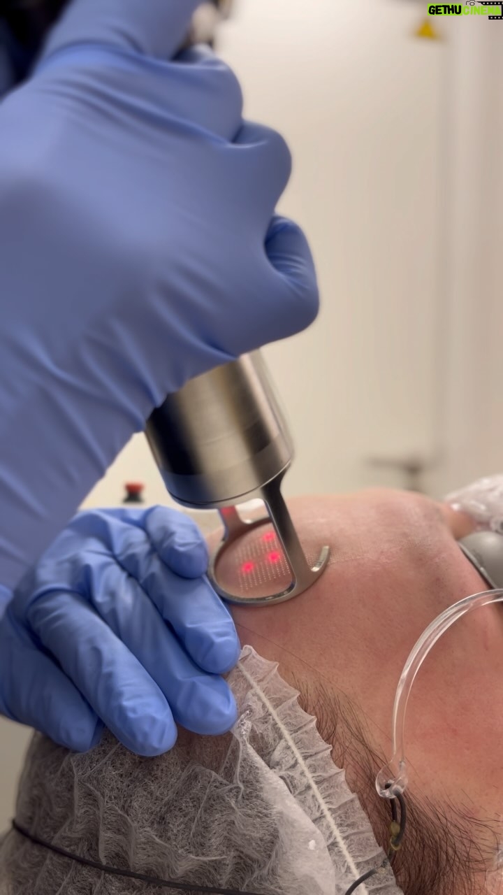 Ma'Ma Queen Instagram - Een van onze favorieten behandelingen die we bij Signé mogen uitvoeren, is de CO2-laser 🤍. De laser wordt ingezet voor huidverstrakking, het verminderen van (acne)littekens en bij het behandelen van een grove huidstructuur. De huid wordt tijdens de behandeling gecontroleerd beschadigd, waardoor het lichaam wordt aangespoord om collageen aan te maken. Na een herstelperiode van ongeveer een week is het resultaat een stralende, stevige en vernieuwende huid! Wij hebben @iammamaqueen mogen ontvangen in onze kliniek voor de CO2-behandeling. Zij zal het verdere proces met jullie delen, stay tuned🤍