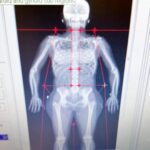 Meaghan B. Murphy Instagram - I'm #celiac, which means #gluten is the enemy, and I don't sufficiently absorb nutrients from food. This often leaves me Vitamin D deficient w/o supplements. I worry about my bone density as a result. I was excited for the DEXA (dual x-ray absorptiometry) scan at @princetonlongevity to determine my osteoporosis risk. 🩻 How it works: A very small dose of ionizing radiation produces pictures of your body—hips, spine, wrist. 🦴The non-invasive scan then analyzes these pictures to calculate how dense your bones are or if you're at risk for fractures. It's the gold standard diagnostic tool for osteoporosis. DEXA also measures body fat percentage, fat mass and fat free mass. (More on that in a second.) Turns out my bones are strong! I got my BMC (Bone Mineral Content) number aka the amount of bone tissue your skeleton currently has, as well as a T-score. The T-score is the standard by which doctors measure your bone mineral density. You want a score of +1 to -1 because it indicates normal bone mineral density. I'm at a 1.5. YAY! The thing that did shock me was my Body Mass Index. BMI calculated by taking your weight in KG and dividing it by the square of your height in meters is total bull! That formula doesn't account for body composition. You could have a body fat percentage of 10%, weigh 220lbs, have a height of 5'11, and be classified as obese. What?! DEXA is legit. It measures Fat Mass (amount of fat stored in your body in grams) and Lean Mass (skin, organs, muscles, water). Then it takes the sum of Lean Mass & Bone Mineral Content to come up with your Fat Free Mass. From here, DEXA determines what % of your body is composed of stored fat. Even though I am within 3lbs of my "ideal" weight, my total body fat was a surprising 26.7%. I was a little floored by that number. At my current weight of 128, I am made up of 34lbs of fat & 94lbs of lean mass. For optimal health, I'd like to swap 3lbs of fat for 3lbs of muscle. Knowing my aerobic capacity is at the 100th percentile for my age, this info is a nice nudge to do more weight training. Knowledge is power! Link in bio to learn more about PLC. #dexa #bonedensity #bonehealth #bodyfat #preventativehealth Princeton Longevity Center