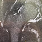 Paul Felder Instagram - Some bad news this week. Anyone close to me knows that I’ve had some hip issues for years. I have been kicking/doing martial arts since I was a 12 year old boy and all of that kicking and rotating has taken a big toll. After a hard bike and run this week I woke up in some serious discomfort, had livery little range of motion in my right hip. I reached out to Heather and Dr D with the ufc to help set up an mri (finally) long story short…I have the hips of an 80 year old man. I have no soft tissue left and am grinding bone on bone. I don’t know what’s next! I have to speak with some specialists and find out. I am pretty sure my season of racing is over. I just truly hope this ain’t the end. For now time to focus on family time and work!