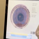 Pedro Figueira Instagram - MI PRIMERA OPERACIÓN! 👁️🫣 Apenas puedo ver el teléfono de vuelta y les admito que me operé la vista por fin :’) tenía demasiadas ganas de hacérmelo desde hace muchos años y ya tengo la edad de ser candidato a la operación. Obviamente me dio demasiado nervios porque ajá mrk es EL OJO y ayer casi pensé que me iba a quedar ciego pero gracias a dios todo salió súper bien, no me dolió nada de nada al momento. La recuperación si fue un día de lágrimas y dolor y hasta pensé que me iba a quedar así (veía demasiado borroso) pero ya hoy como nueva. Llevo desde los 12 utilizando lentes y no puedo creer que ya puedo ver bien tan inmediatamente 🫡 #lasik SE LAS RECOMIENDO 🤞🏼
