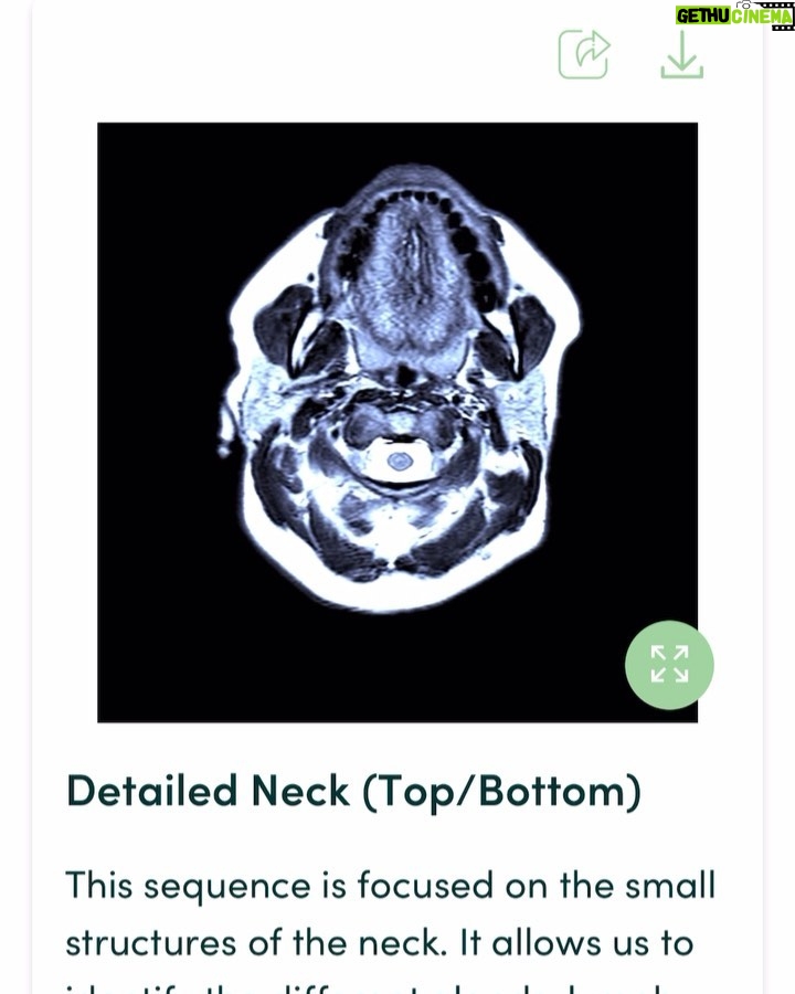Ricki Lake Instagram - So guys, exactly a month ago I went in for my @prenuvo mri scan. And my results are in! I will admit, I was a little nervous after learning that 1 in 20 people have significant findings turn up. Elated to report back that there was no major issues with this 54 year old! The report itself is so extensive and so thorough. The nurse practitioner talked me through my entire scan results. Overall this was an amazing experience, and I will be back in two years to do a follow up as a preventative measure. So grateful for this technology! I highly recommend you make your appointment for your own scan. Use this promo code : prenuvo.com/Ricki for $300 off. Prenuvo uses advanced MRI to perform a full body scan able to detect solid cancerous tumors at stage 1 and around 500 other conditions (including aneurysms, spine herniations, fatty liver disease). The vast majority of the cancers and medical conditions found are at an early stage, where treatment is easier and much more likely to be successful. Unlike other screening mechanisms, Prenuvo does not use radiation or contrast, making it a safe preventative screening tool. On average, Prenuvo gives a potentially life-saving diagnosis to 1/20 people. Many of these diagnoses occur in patients that are asymptomatic. Thank you @prenuvo I am relieved and grateful. #prenuvo #sponsored #preventativehealth #health #moderntechnology