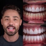 Rico Melquiades Instagram - CALADO VENCE!!! E venceuuu 🏆 Realizamos o caso do @ricoof, uma experiência excepcional, um RETRABALHO das Lentes de Porcelanas. Foram instalados 20 Elementos, da cor BL1 HT, 🦷💎 Caso realizado pelos Drs: @caproni.drjanderson @caproni.dragisele . . . . ———————————— De acordo com a resolução CFO 196/19, que autoriza a divulgação de imagens relativas ao diagnósticos e ao resultado final. Lembrando que o resultado é único e individual à cada paciente. Duvidas envie nos um direct! @drviotto @ricomelquiades #lentesdecontatodental #lentes #sorriso #transformação #sorriso #brasil #smile #reels #foto .