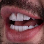 Rico Melquiades Instagram - CALADO VENCE!!! E venceuuu 🏆 Realizamos o caso do @ricoof, uma experiência excepcional, um RETRABALHO das Lentes de Porcelanas. Foram instalados 20 Elementos, da cor BL1 HT, 🦷💎 Caso realizado pelos Drs: @caproni.drjanderson @caproni.dragisele . . . . ———————————— De acordo com a resolução CFO 196/19, que autoriza a divulgação de imagens relativas ao diagnósticos e ao resultado final. Lembrando que o resultado é único e individual à cada paciente. Duvidas envie nos um direct! @drviotto @ricomelquiades #lentesdecontatodental #lentes #sorriso #transformação #sorriso #brasil #smile #reels #foto .