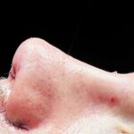 Rico Melquiades Instagram - Hoje eu pude realizar um grande sonho, que era fazer minha rinoplastia e através da Apoline conheci uma profissional maravilhosa que cuidou com todo carinho do meu nariz, e me surpreendeu positivamente com os resultados. | CRMPB 7350 | RQE 4786