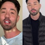 Rico Melquiades Instagram - Finalmente veio aí! 🫣Depois de passar anos sendo chamada de feia na internet, me rendi as cirurgias plásticas na face e mostro AGORA o resultado pra vocês! Agradeço a Deus, a @dramarianafelinto e a vocês por me apoiarem! 🫶 Arrasta para o lado e veja a diferença do antes e depois! ➡️