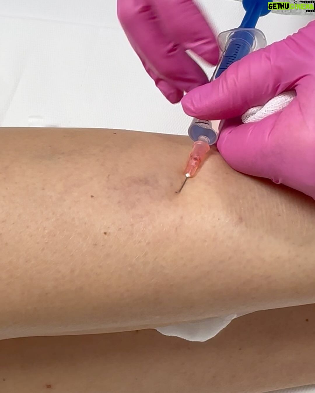 Sandra Parmová Instagram - Jestli máte rádi okamžitý zkrášlovací WOW efekt, mrkněte do galerie 💉🙀 Na sklerotizaci, tedy “vymizíkování” křečových žil jsem už byla, ale někdy to bývá trochu boj s větrnými mlýny😝 A zrovna u mě bylo potřeba zákrok zopakovat, protože metličkové žilky vypadaly tak trochu jako modřiny 🙈 Pokud na křečové žíly také trpíte, teď v zimě je nejlepší období to pořešit, protože je pak potřeba ještě 4 týdny nosit kompresní punčošky☺️ Ale to se zrovna v tomhle počasí dost hodí ❄️🌡️😅 A za ty krásné nožky to stojí 💃🏼🤩 Děkuji opět za skvělou péči, @medicomclinic. Možná se to z videí nezdá, ale rozhodně to nějak dramaticky nebolí. Jen to trochu štípne 💉😉 A paní doktorka @sabina.sellner umí trefit opravdu i tak drobné žilky, že jsem tomu ani sama nevěřila😍 Kdyby vás cokoliv zajímalo, klidně se v komentářích zeptejte. Můžeme tady sdílet třeba i vaše zkušenosti. ❤️ #krecovezily #zily #sklerotizace #medicomclinic #brno #vinicni #medicomgirl #letoseblizi #nejlepsizmenyjsoutyklepsimu #krasnenohy Brno, Czech Republic