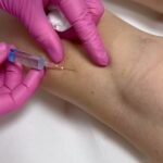 Sandra Parmová Instagram - Jestli máte rádi okamžitý zkrášlovací WOW efekt, mrkněte do galerie 💉🙀 Na sklerotizaci, tedy “vymizíkování” křečových žil jsem už byla, ale někdy to bývá trochu boj s větrnými mlýny😝 A zrovna u mě bylo potřeba zákrok zopakovat, protože metličkové žilky vypadaly tak trochu jako modřiny 🙈 Pokud na křečové žíly také trpíte, teď v zimě je nejlepší období to pořešit, protože je pak potřeba ještě 4 týdny nosit kompresní punčošky☺️ Ale to se zrovna v tomhle počasí dost hodí ❄️🌡️😅 A za ty krásné nožky to stojí 💃🏼🤩 Děkuji opět za skvělou péči, @medicomclinic. Možná se to z videí nezdá, ale rozhodně to nějak dramaticky nebolí. Jen to trochu štípne 💉😉 A paní doktorka @sabina.sellner umí trefit opravdu i tak drobné žilky, že jsem tomu ani sama nevěřila😍 Kdyby vás cokoliv zajímalo, klidně se v komentářích zeptejte. Můžeme tady sdílet třeba i vaše zkušenosti. ❤️ #krecovezily #zily #sklerotizace #medicomclinic #brno #vinicni #medicomgirl #letoseblizi #nejlepsizmenyjsoutyklepsimu #krasnenohy Brno, Czech Republic