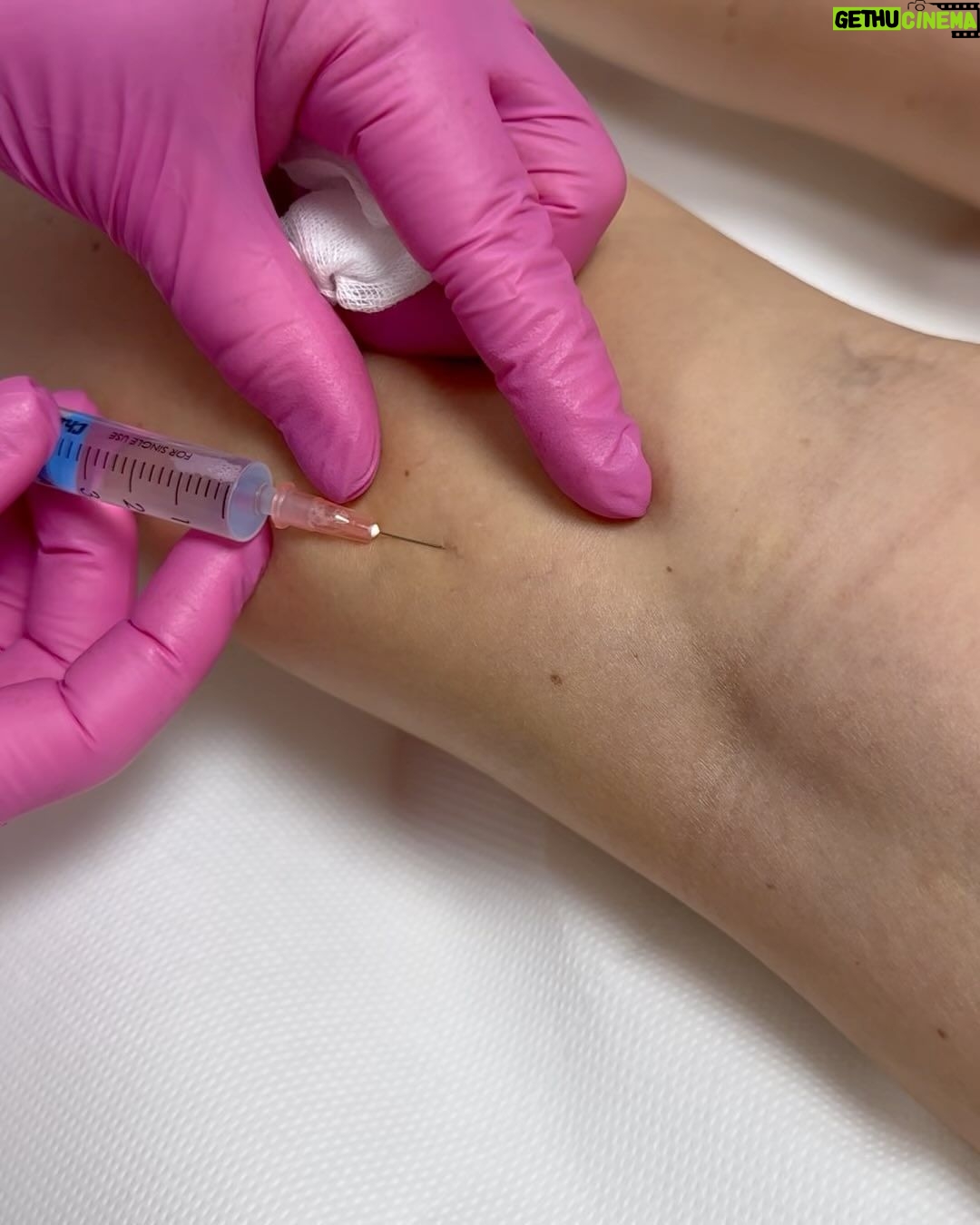 Sandra Parmová Instagram - Jestli máte rádi okamžitý zkrášlovací WOW efekt, mrkněte do galerie 💉🙀 Na sklerotizaci, tedy “vymizíkování” křečových žil jsem už byla, ale někdy to bývá trochu boj s větrnými mlýny😝 A zrovna u mě bylo potřeba zákrok zopakovat, protože metličkové žilky vypadaly tak trochu jako modřiny 🙈 Pokud na křečové žíly také trpíte, teď v zimě je nejlepší období to pořešit, protože je pak potřeba ještě 4 týdny nosit kompresní punčošky☺️ Ale to se zrovna v tomhle počasí dost hodí ❄️🌡️😅 A za ty krásné nožky to stojí 💃🏼🤩 Děkuji opět za skvělou péči, @medicomclinic. Možná se to z videí nezdá, ale rozhodně to nějak dramaticky nebolí. Jen to trochu štípne 💉😉 A paní doktorka @sabina.sellner umí trefit opravdu i tak drobné žilky, že jsem tomu ani sama nevěřila😍 Kdyby vás cokoliv zajímalo, klidně se v komentářích zeptejte. Můžeme tady sdílet třeba i vaše zkušenosti. ❤️ #krecovezily #zily #sklerotizace #medicomclinic #brno #vinicni #medicomgirl #letoseblizi #nejlepsizmenyjsoutyklepsimu #krasnenohy Brno, Czech Republic