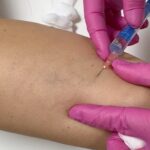 Sandra Parmová Instagram - Jestli máte rádi okamžitý zkrášlovací WOW efekt, mrkněte do galerie 💉🙀 Na sklerotizaci, tedy “vymizíkování” křečových žil jsem už byla, ale někdy to bývá trochu boj s větrnými mlýny😝 A zrovna u mě bylo potřeba zákrok zopakovat, protože metličkové žilky vypadaly tak trochu jako modřiny 🙈 Pokud na křečové žíly také trpíte, teď v zimě je nejlepší období to pořešit, protože je pak potřeba ještě 4 týdny nosit kompresní punčošky☺️ Ale to se zrovna v tomhle počasí dost hodí ❄️🌡️😅 A za ty krásné nožky to stojí 💃🏼🤩 Děkuji opět za skvělou péči, @medicomclinic. Možná se to z videí nezdá, ale rozhodně to nějak dramaticky nebolí. Jen to trochu štípne 💉😉 A paní doktorka @sabina.sellner umí trefit opravdu i tak drobné žilky, že jsem tomu ani sama nevěřila😍 Kdyby vás cokoliv zajímalo, klidně se v komentářích zeptejte. Můžeme tady sdílet třeba i vaše zkušenosti. ❤️ #krecovezily #zily #sklerotizace #medicomclinic #brno #vinicni #medicomgirl #letoseblizi #nejlepsizmenyjsoutyklepsimu #krasnenohy Brno, Czech Republic