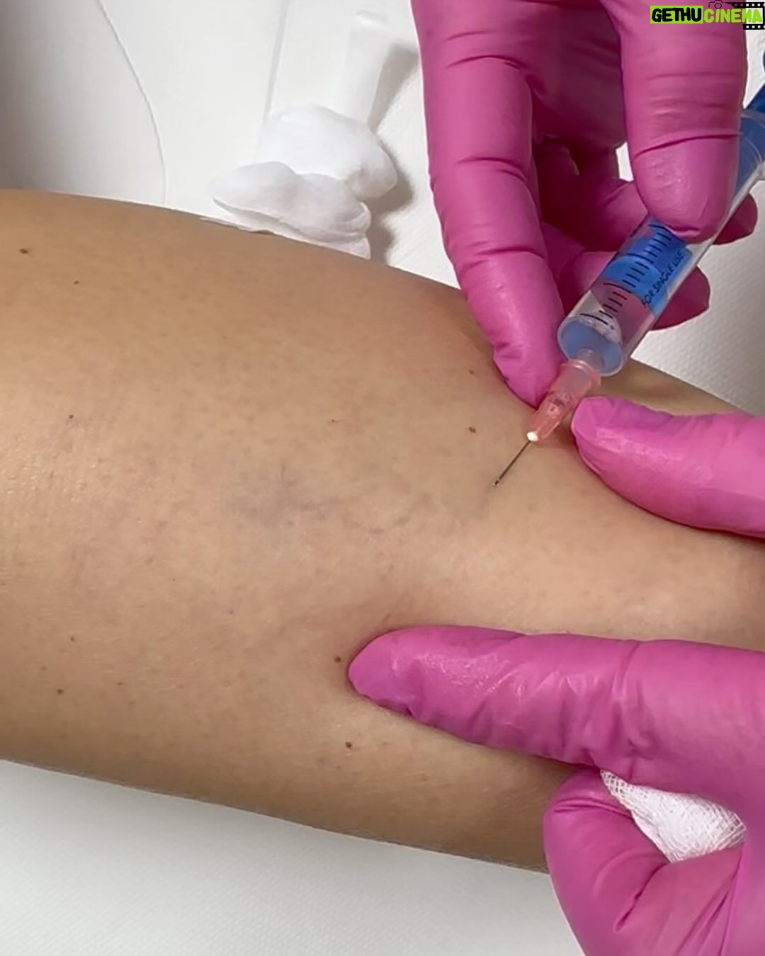 Sandra Parmová Instagram - Jestli máte rádi okamžitý zkrášlovací WOW efekt, mrkněte do galerie 💉🙀 Na sklerotizaci, tedy “vymizíkování” křečových žil jsem už byla, ale někdy to bývá trochu boj s větrnými mlýny😝 A zrovna u mě bylo potřeba zákrok zopakovat, protože metličkové žilky vypadaly tak trochu jako modřiny 🙈 Pokud na křečové žíly také trpíte, teď v zimě je nejlepší období to pořešit, protože je pak potřeba ještě 4 týdny nosit kompresní punčošky☺️ Ale to se zrovna v tomhle počasí dost hodí ❄️🌡️😅 A za ty krásné nožky to stojí 💃🏼🤩 Děkuji opět za skvělou péči, @medicomclinic. Možná se to z videí nezdá, ale rozhodně to nějak dramaticky nebolí. Jen to trochu štípne 💉😉 A paní doktorka @sabina.sellner umí trefit opravdu i tak drobné žilky, že jsem tomu ani sama nevěřila😍 Kdyby vás cokoliv zajímalo, klidně se v komentářích zeptejte. Můžeme tady sdílet třeba i vaše zkušenosti. ❤️ #krecovezily #zily #sklerotizace #medicomclinic #brno #vinicni #medicomgirl #letoseblizi #nejlepsizmenyjsoutyklepsimu #krasnenohy Brno, Czech Republic