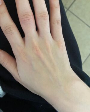 Sasha Clements Instagram - It’s easy to forget our progress! I documented my entire flare up just so I'd have references to look back on and i’m so happy I did! I couldn’t fit this ring on for almost a year (I tried every day). ⁠
⁠
This week has presented some tough challenges and even though my fingers are still sore and I can see where I’m still swollen, I’m beyond grateful for the reminder that there has been improvement!🙏🏼⁠
⁠
A little background- I was diagnosed with RA over 10 years ago. Was treated with Methotrexate and went into “remission”. Meaning my swelling and severe pain went down but I never really got better. I was still achy & sore. Had major brain fog & exhaustion to the point Corbin made me test for narcolepsy. I was always dealing with inflammation/ infections. I was constantly breaking out into rashes and hives and would be on Prednisone multiple times a year. So I was in "remission" but I wasn’t thriving - I was surviving. ⁠
⁠
When I flared up again I was once again diagnosed with RA - then Lupus - then they added Lyme. With more testing we found I had high levels of mercury & lead, high toxic exposure, activated EBV, major vitamin deficiencies, hormonal imbalances, and mitochondrial dysfunction. ⁠
⁠
I’ve been on a few different meds all with their lovely side effects🙄 Some have helped but I didn’t want to repeat the same pattern of just putting this bandaid on the pain. So here are some other things that have helped immensely!⁠ 
⁠
-Working with a functional medicine doctor & getting testing done though them. Finding a mentor to guide me. I eat ZERO processed food, sugar, gluten, dairy, legumes, nuts, caffeine. I cook all of my food at home. I’ve tried many diets - AIP, low salicylate, carnivore, paleo, vegan, pescatarian and I found the trick is to just create your own diet prescription- your body knows what it needs. I take a rainbow of supplements, upped my water intake, practice gratitude, meditation, food combining, hot & cold therapy (sauna & cold showers), fasting, breath work, stretching, exercise, juicing, a wind down routine, & get good sleep.⁠
⁠
It's a lot and wasn't achieved overnight but each layer you add will only get you closer to healing ❤️⁠
⁠