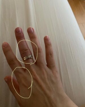 Sasha Clements Instagram - It’s easy to forget our progress! I documented my entire flare up just so I'd have references to look back on and i’m so happy I did! I couldn’t fit this ring on for almost a year (I tried every day). ⁠
⁠
This week has presented some tough challenges and even though my fingers are still sore and I can see where I’m still swollen, I’m beyond grateful for the reminder that there has been improvement!🙏🏼⁠
⁠
A little background- I was diagnosed with RA over 10 years ago. Was treated with Methotrexate and went into “remission”. Meaning my swelling and severe pain went down but I never really got better. I was still achy & sore. Had major brain fog & exhaustion to the point Corbin made me test for narcolepsy. I was always dealing with inflammation/ infections. I was constantly breaking out into rashes and hives and would be on Prednisone multiple times a year. So I was in "remission" but I wasn’t thriving - I was surviving. ⁠
⁠
When I flared up again I was once again diagnosed with RA - then Lupus - then they added Lyme. With more testing we found I had high levels of mercury & lead, high toxic exposure, activated EBV, major vitamin deficiencies, hormonal imbalances, and mitochondrial dysfunction. ⁠
⁠
I’ve been on a few different meds all with their lovely side effects🙄 Some have helped but I didn’t want to repeat the same pattern of just putting this bandaid on the pain. So here are some other things that have helped immensely!⁠ 
⁠
-Working with a functional medicine doctor & getting testing done though them. Finding a mentor to guide me. I eat ZERO processed food, sugar, gluten, dairy, legumes, nuts, caffeine. I cook all of my food at home. I’ve tried many diets - AIP, low salicylate, carnivore, paleo, vegan, pescatarian and I found the trick is to just create your own diet prescription- your body knows what it needs. I take a rainbow of supplements, upped my water intake, practice gratitude, meditation, food combining, hot & cold therapy (sauna & cold showers), fasting, breath work, stretching, exercise, juicing, a wind down routine, & get good sleep.⁠
⁠
It's a lot and wasn't achieved overnight but each layer you add will only get you closer to healing ❤️⁠
⁠