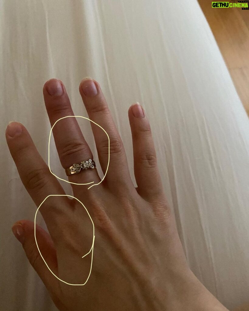 Sasha Clements Instagram - It’s easy to forget our progress! I documented my entire flare up just so I'd have references to look back on and i’m so happy I did! I couldn’t fit this ring on for almost a year (I tried every day). ⁠ ⁠ This week has presented some tough challenges and even though my fingers are still sore and I can see where I’m still swollen, I’m beyond grateful for the reminder that there has been improvement!🙏🏼⁠ ⁠ A little background- I was diagnosed with RA over 10 years ago. Was treated with Methotrexate and went into “remission”. Meaning my swelling and severe pain went down but I never really got better. I was still achy & sore. Had major brain fog & exhaustion to the point Corbin made me test for narcolepsy. I was always dealing with inflammation/ infections. I was constantly breaking out into rashes and hives and would be on Prednisone multiple times a year. So I was in "remission" but I wasn’t thriving - I was surviving. ⁠ ⁠ When I flared up again I was once again diagnosed with RA - then Lupus - then they added Lyme. With more testing we found I had high levels of mercury & lead, high toxic exposure, activated EBV, major vitamin deficiencies, hormonal imbalances, and mitochondrial dysfunction. ⁠ ⁠ I’ve been on a few different meds all with their lovely side effects🙄 Some have helped but I didn’t want to repeat the same pattern of just putting this bandaid on the pain. So here are some other things that have helped immensely!⁠ ⁠ -Working with a functional medicine doctor & getting testing done though them. Finding a mentor to guide me. I eat ZERO processed food, sugar, gluten, dairy, legumes, nuts, caffeine. I cook all of my food at home. I’ve tried many diets - AIP, low salicylate, carnivore, paleo, vegan, pescatarian and I found the trick is to just create your own diet prescription- your body knows what it needs. I take a rainbow of supplements, upped my water intake, practice gratitude, meditation, food combining, hot & cold therapy (sauna & cold showers), fasting, breath work, stretching, exercise, juicing, a wind down routine, & get good sleep.⁠ ⁠ It's a lot and wasn't achieved overnight but each layer you add will only get you closer to healing ❤️⁠ ⁠