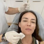 Sema Şimşek Instagram - @mevlutdag.dr hocamdan da fırçayı yedim bir nevi. 🫣Neler yapmak istiyor bana, maalesef olamıyor. Ama sıcak kolajen alerji testinden başarıyla geçtik 🙏🏼🤗 biraz geç paylaşmakla birlikte sıcak kolejeni uygulayalı 4 gün oldu ve inanın fark etmeye başladı. 15.ci günü görmek için sabırsızlanıyorum. 🤩 ve o gün geldiğinde size yeni bir video çekip paylaşıcam ✨💛 @salvecoll_turkey @stemturk #sıcakkolajen #uygulama #nofilter #semasimsek #mevlütdağ Dr. Mevlüt DAĞ