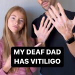 Shaylee Mansfield Instagram – Real talk… my Deaf dad has vitiligo and we had a chat about his journey. Vitiligo or not. Deaf or not. Or whatever it is. It’s time to embrace people of all kinds. 💜✨ Los Angeles, California