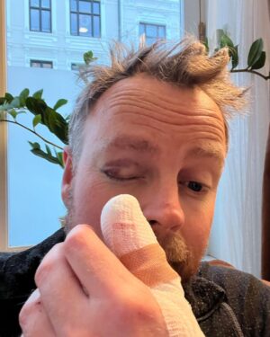 Torbjørn Røe Isaksen Instagram - Jeg hugget av en anselig del av tommelen i dag. Med øks. Tøffest slik. Neste runde vurderer jeg tattis — grenlandstyle. Godt nytt år! (Blåmerke — du skulle sett han andre, neida, joda, neida).