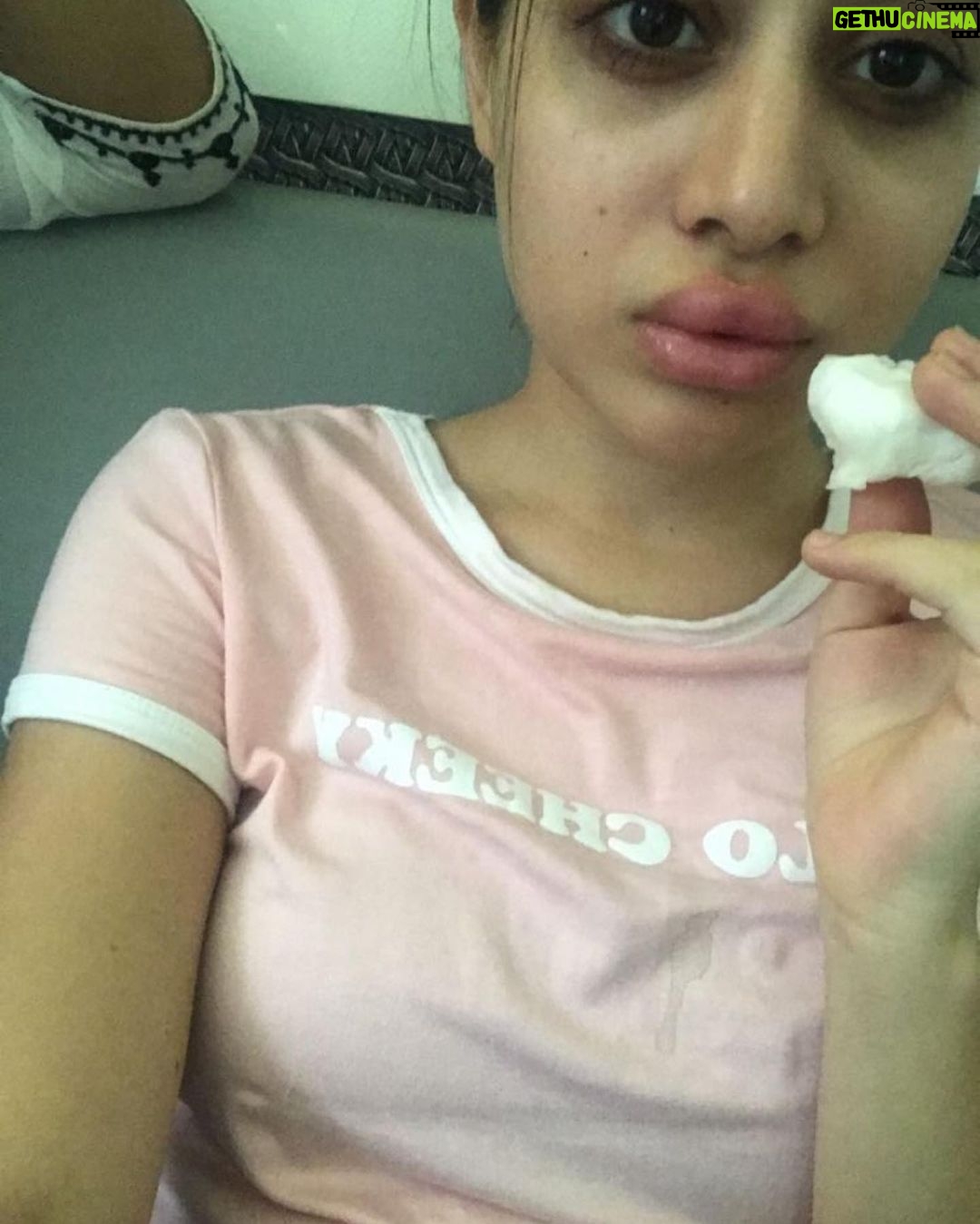 Urfi Javed Instagram - Just clarifying to these pictures are from 2016-2017 , not current Sharing with you all my lip filler journey I’ve been getting lip fillers from the age of 18 , I didn’t have that much money back then but I always felt my lips were too thin and I wanted bigger fuller lips . I went to dermat deni we’re ready to do it for less and these were the results at times ! I had to get them dissolved and mind it it’s the most painful thing ever !! I’m not telling people to not get them but Infact what I’m trying to say is just be careful while getting fillers or Botox . I still very much have lip fillers just that I know what suits my face and I know now less is more . Encouraging everyone to throughly research before going to any doctor . I actually revvokend fillers to everyone , if you have some insecurities about your face or body instead of hating yourself or your face it’s just better to opt for fillers or surgeries but but but from a very good doctor only.