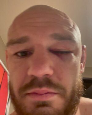 Viacheslav Borshchev Instagram - Because of eye poke I went to the hospital and have missed post fight interview, and I did not have the opportunity to thank all those involved, or at least the most involved.
My wife @borshcheva__m , i don’t remember if I ever had such a strong support from you and now I know, together, we can reach any goals we want. 
My team @teamalphamalemma ( @kickboxingvlg )main couches @urijahfaber , @joey_rodriguez916 , @lastcall155 , @mvmnt_darren .
extra thank to @urijahfaber for opening so many doors for me. 
Thank you @seaneaddy for giving me a hand in such a tough life moment.
Thank @ufcpi for helping me prepare so well, probably better then ever.
@the_massage_messiah @getmegoings your massage was big part my last camp thank you I felt amazing during the fight 
Thank Violetta Mordukhay the best lawyer in the game, she gave me big relief in right time. 

And of course thank @ufc , @seanshelby and @danawhite personally for giving me opportunity to show my skills and let people enjoy pure violence.
#viacheslav_borshchev #slava_claus #teamalphamale #sacramento #volgograd #mma #ufc #fight