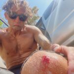 Casey Neistat Instagram - trying to teach Ilya how to surf. also I was either attacked by a shark or bumped my knee in a rock.. not sure which one