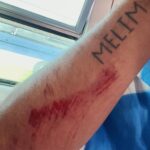Diogo Melim Instagram - acabou-se o q era doce. ÉPICO. deu pra curtir mt, criamos memórias eternas e essa linda marca de guerra na foto 5 onde rolei igual jaca podre nas escadas do metrô, mas sou abençoado ninguém viu além dela. não passei essa vergonha e economizei alguns anos de terapia. ontem tava no coliseu de Roma e quinta estaremos no coliseu de Lisboa, uma puta ideia da galera do marketing, meus parabéns. 27.07 - Lisboa, PT | Coliseu 28.07 - Lousada, PT | Festas Grandes de Lousada 29.07 - Vilamoura/Algarve, PT | Bliss … 19.08 - DVD Melim, BR | Vibra São Paulo