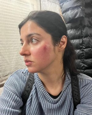 Divya Khosla Kumar Instagram - Got badly injured during an action sequence for my upcoming project. But the show must go on.
Need all your blessings and healing energy 🙏🏻