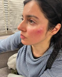 Divya Khosla Kumar Instagram - Got badly injured during an action sequence for my upcoming project. But the show must go on. Need all your blessings and healing energy 🙏🏻