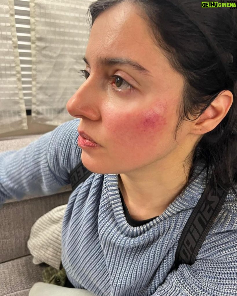 Divya Khosla Kumar Instagram - Got badly injured during an action sequence for my upcoming project. But the show must go on. Need all your blessings and healing energy 🙏🏻