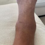 Dolph Lundgren Instagram - Finally doing surgery on my left ankle. I’ve had this injury since my time in the military. During 40 years of martial arts and doing action films, it’s been a fight every day. The joint is now basically destroyed. Directing and starring in Wanted Man really did it in…Can’t wait to be able to walk normally again. 🙏👌👊 Will keep you posted.